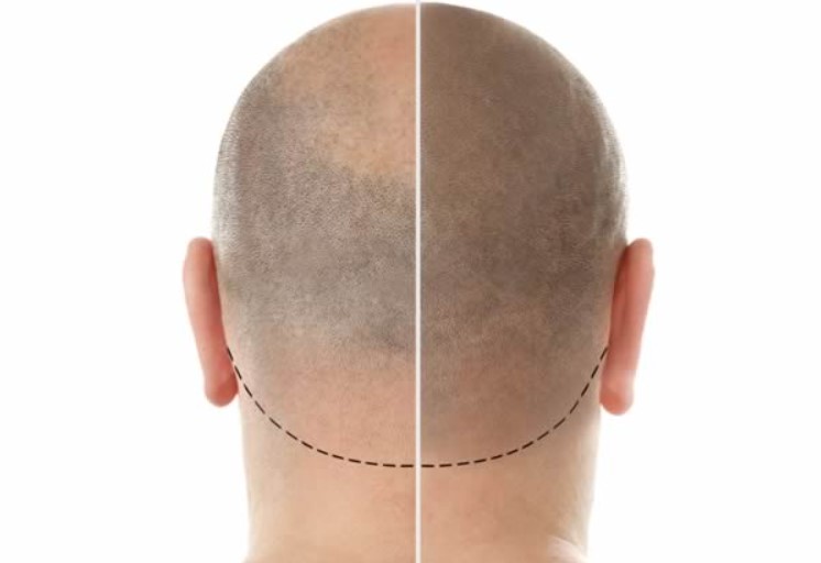 Micropigmentation of the Scalp Giving Bald People a Second Chance
